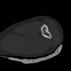 SPORK, NICO - 22.03.1976 - 02.08.2022 - CT obere Extremität - 18:02:23